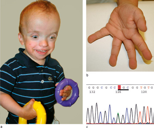 Figur 2  a) Pasient 1 med Costellos syndrom og mutasjon i HRAS-genet, alder tre &aring;r og ni m&aring;neder. b) Pasientens h&aring;nd med&hellip;
