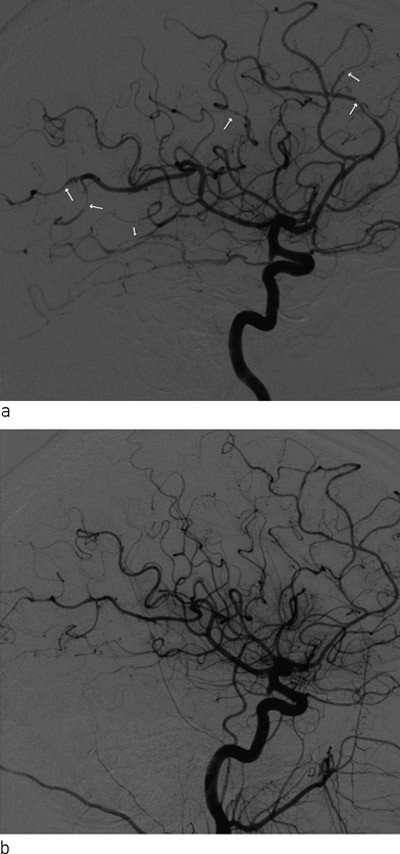 Figur 2  Intraarteriell cerebral angiografi med a) fremstilling av hjernearteriene p&aring; h&oslash;yre side ved innkomst og b) ved&hellip;
