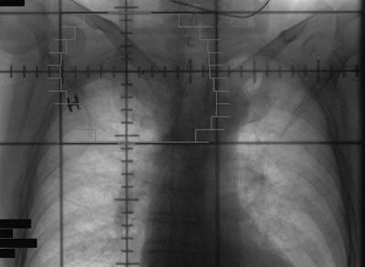Figur 3  Str&aring;lefeltet innbefattet tumor med margin