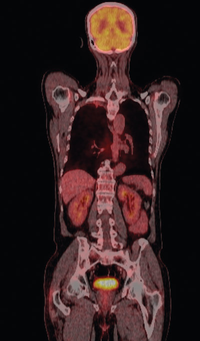 Figur 4  PET-CT viser lett &oslash;kt opptak i tumor i h&oslash;yre lunge, uten opptaks&oslash;kning i thoraxvegg. Det er svakt opptak i lungevev&hellip;