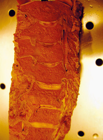 Figur 3  Frontalsnitt gjennom cervikalcolumna (anatomisk preparat) med tydelige spalter i mellomvirvelskivene. Foto P. Holck