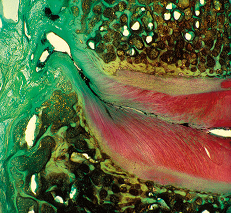 Figur 4  Frontalsnitt gjennom cervikal mellomvirvelskive med tydelig forskjellig fiberretning i retning mot spalten&hellip;