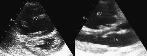 Figur 1  Ekkokardiografisk parasternalt kortaksebilde (venstre) og parasternalt langaksebilde (h&oslash;yre) ved innkomst. H&oslash;yre&hellip;