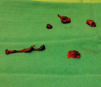 Figur 3  Trombotisk materiale som ble fjernet under operasjonen