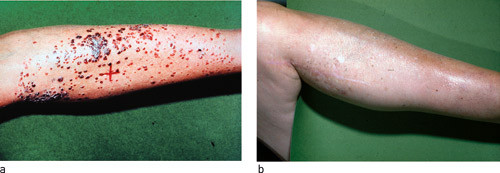 Figur 1  Ekstremitetslokaliserte melanommetastaser a) f&oslash;r og b) 39 m&aring;neder etter kombinasjonsbehandling med intraarteriell 5&hellip;