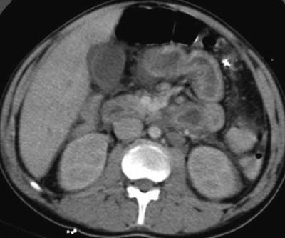 Figur 1  CT abdomen viser betydelig veggfortykkelse i tynntarmen (8&ndash;9 mm)