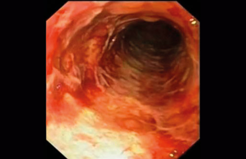 Figur 2  Endoskopisk bilde fra colon descendens som viser lettbl&oslash;dende slimhinne med omfattende ulcerasjoner