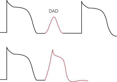 Figur 2  Sene etterdepolariseringer (delayed after depolarizations, DAD). Defekte ryanodinreseptorer kan f&oslash;re til &oslash;kt niv&aring;&hellip;