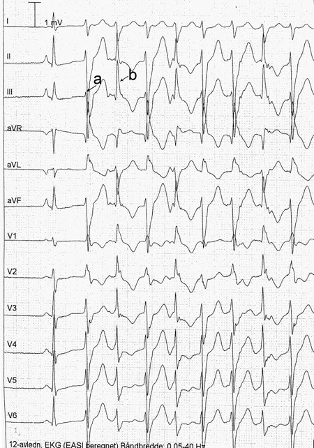 Figur 3  Bidireksjonal ventrikkeltakykardi kjennetegnes av at R-b&oslash;lgeaksen roterer 180&deg; fra slag til slag. (R-b&oslash;lgeaksen i&hellip;