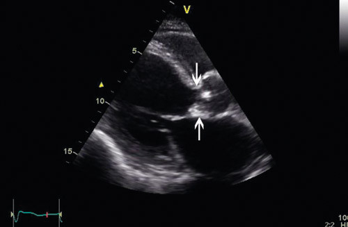 Figur 1  Ekkokardiografi ble utf&oslash;rt kort tid etter innleggelsen. Aortaklaffen var trikuspid, med en endokardittsuspekt&hellip;