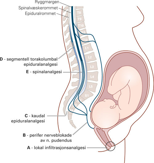 Figur 1  Skjematisk fremstilling av mulige angrepspunkter for regionalanestesi og -analgesi med lindring av f&oslash;dselssmerter&hellip;