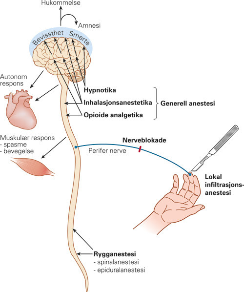 Figur 1  Ledning av smerte og nosiseptiv stimulering med potensielle &laquo;angrepspunkter&raquo; for anestesi. Kirurgiske inngrep&hellip;