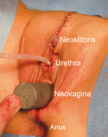 Figur&nbsp;2&nbsp;&nbsp;Resultatet etter genital kj&oslash;nnskonvertering fra mann til kvinne umiddelbart etter 2. seanse. Blokkestaven er&hellip;