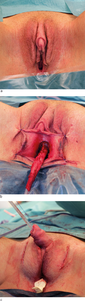 Figur&nbsp;4&nbsp;&nbsp;Rekonstruksjon med metoidioplastikkteknikk. a) Klitorishypertrofi etter testosteronbehandling. &nbsp;b) Peroperativt&hellip;