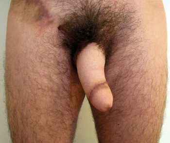 Figur&nbsp;5&nbsp;&nbsp;Postoperativt bilde etter genital kj&oslash;nnskonvertering med konvensjonell falloplastikk med bruk av hud fra h&oslash;yre&hellip;