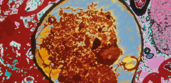 Perifer nevropati, elektronmikrografi. Illustrasjonsfoto Science Photo Library/GV-Press/NordicPhotos