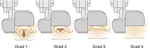 Figur 2  Gradering av innsynsforhold til larynx ved direkte laryngoskopi etter Cormack & Lehane (8). a) Grad 1 (hele larynx&hellip;
