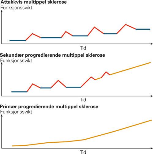 Figur 1  Sykdomsforl&oslash;p ved multippel sklerose
