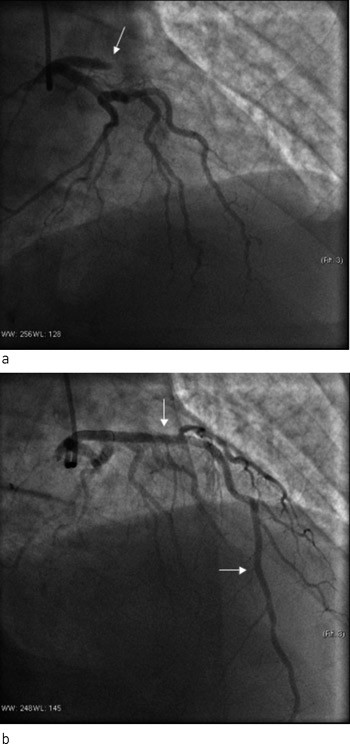 Figur 1  Selektiv koronarangiografi hos en mann i 60-&aring;rene med nye brystsmerter f&aring; timer etter utf&oslash;rt akutt angioplastikk av&hellip;