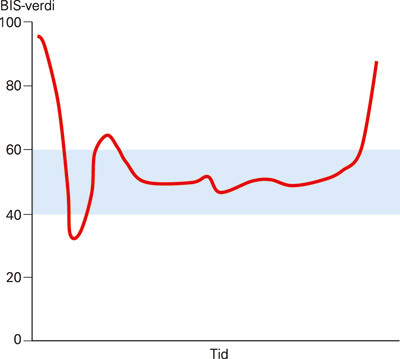 Figur 3  Figuren viser et typisk forl&oslash;p av trendkurven for bispektral indeks (BIS) under en ukomplisert narkose. P&aring; y-aksen&hellip;