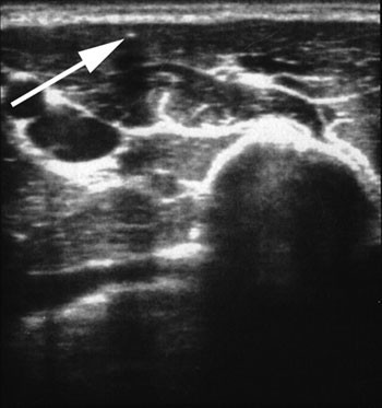 Figur 3  Lokalisering av implantatet er gjort ultralydveiledet med et 11 MHz line&aelig;rt lydhode. I tverrsnitt ses implantatet&hellip;