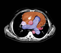 Perikardial effusjon, CT-bilde. Illustrasjonsfoto &copy; Photo Researchers/GV-Press/NordicPhotos