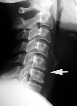 Figur 2  Sju &aring;r senere volder skaden pasienten atskillige plager
