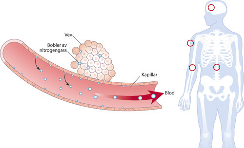 Figur 1  Etter avsluttet dykk kan det dannes gassbobler i vevene og i kapillarene. Symptomfrie ven&oslash;se gassemboluser kan&hellip;
