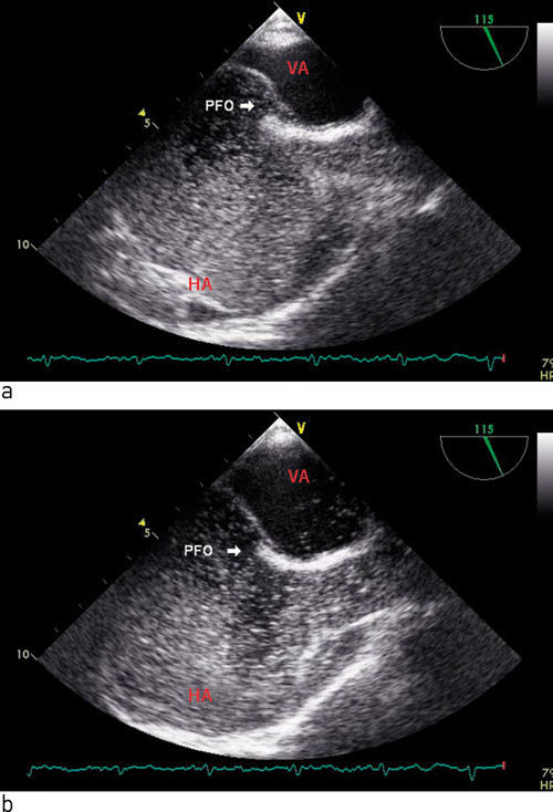 Figur 2  Trans&oslash;sofageal ekkokardiografi med a) mikrobobler i h&oslash;yre atrium (HA) og med b) overgang til venstre atrium (VA)&hellip;