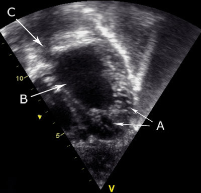 Figur 2  Ekkokardiografisk bilde av pasientens hjerte (venstre ventrikkel) ved diagnosetidspunkt. P&aring; bildet ses venstre&hellip;