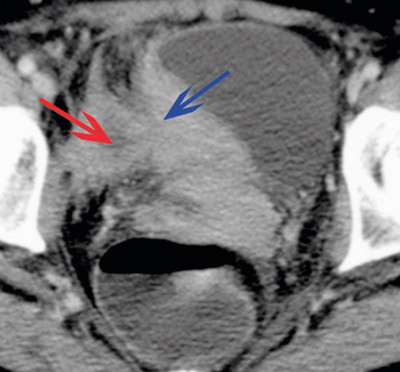 Figur 1  Aktinomykose i bekkenet som abscess (MR). Fortykket urinbl&aelig;revegg (bl&aring; pil). Diffust avgrenset cystisk oppfylling&hellip;