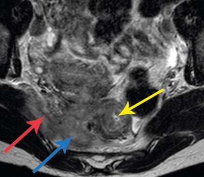 Figur 2  Aktinomykose i bekkenet som fibr&oslash;s tumor (MR). Det er en perirektal tumor (bl&aring; pil) og fortykket rectumvegg (gul&hellip;
