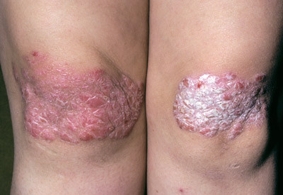 Psoriasis. Illustrasjonsfoto &copy; ISM/PhotoTake/GV-Press/NordicPhotos