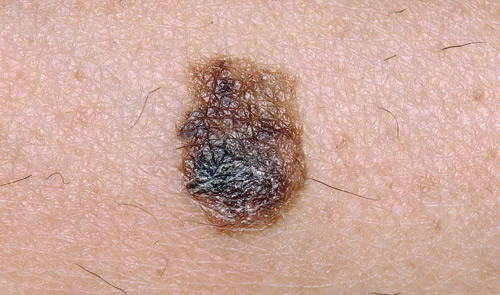Melanom. Illustrasjonsfoto &copy; PhotoTake/GV-Press/NordicPhotos