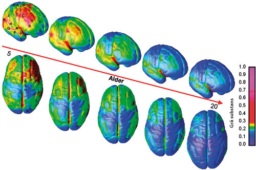 Figur 1  Dynamiske forandringer av kortikal gr&aring; substans. S&oslash;ylen til h&oslash;yre viser volum av gr&aring; substans. I frontallappen n&aring;r&hellip;