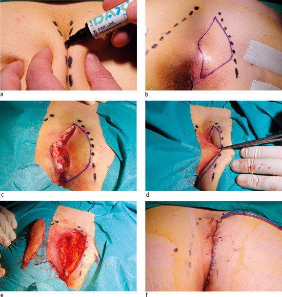 Figur 2  Trinnvis illustrasjon av kirurgisk behandling av pilonidal sykdom. a) Midtlinjen markeres med tusj med pasienten i&hellip;