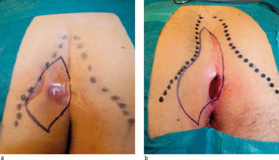Figur 4  To ulike varianter av Bascoms kl&oslash;ft-l&oslash;ft-operasjon avhengig av den kraniokaudale utbredelsen av pilonidal sykdom. a&hellip;