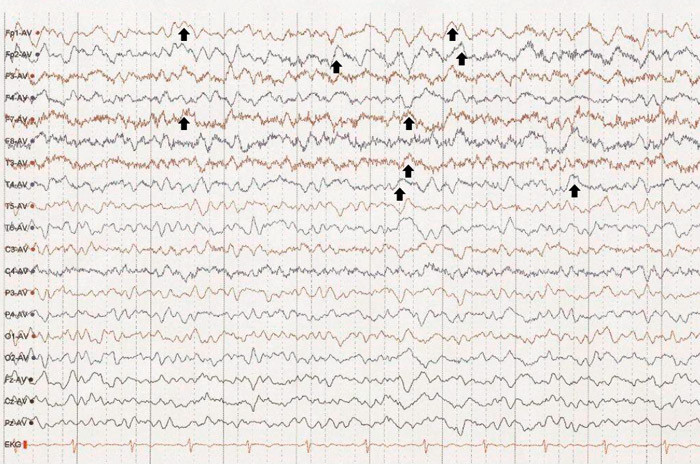 Figur 1  EEG-registrering f&oslash;r oppstart av behandling med steroider er patologisk og viser et uryddig og uregelmessig&hellip;