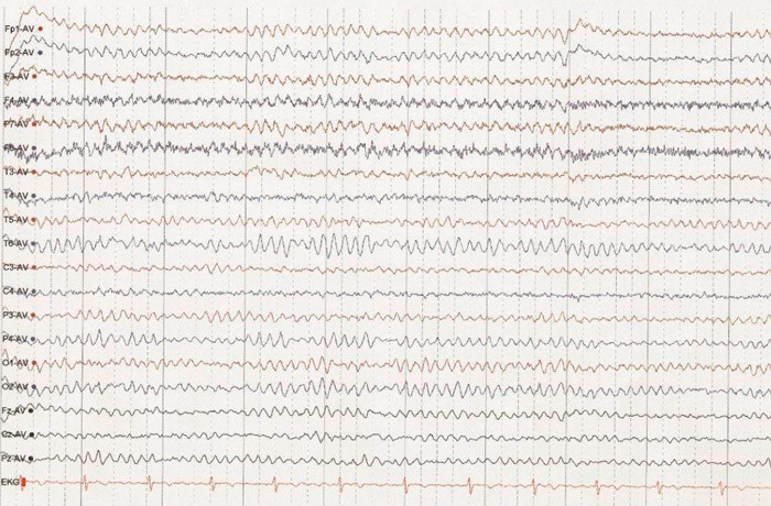Figur 2   EEG-registrering ca. seks uker etter oppstart med steroidbehandling viser normalisering av kurvebildet med en&hellip;