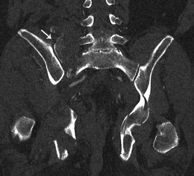 Figur 2  P&aring; h&oslash;yre side er det en knusing av massa lateralis sacrii (pil). I tillegg ses fraktur av fremre bekkenring med&hellip;