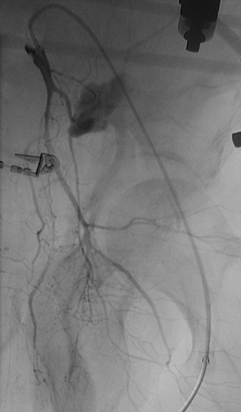Figur 3  Angiografi viste rikelig bl&oslash;dning fra en gren av venstre a. iliaca interna