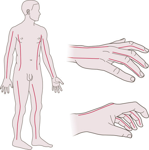 Figur 2  Akuttkirurgi &ndash; eskarotomi. R&oslash;de linjer indikerer anbefalt snittf&oslash;ring ved eskarotomi. Ved behov eskarotomeres&hellip;