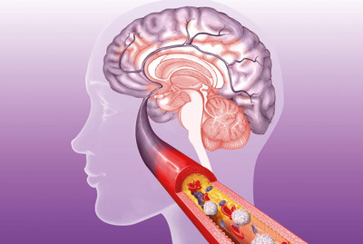 Trombose i cerebral arterie. Illustrasjon &copy; Jeremy Catry/BSIP/GV-Press/NordicPhotos