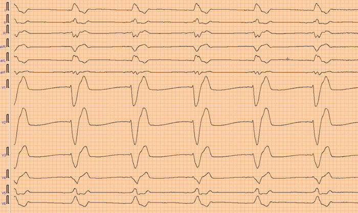 Figur 1  EKG ved innkomst med bradykardi og betydelig bredde&oslash;kt QRS-kompleks