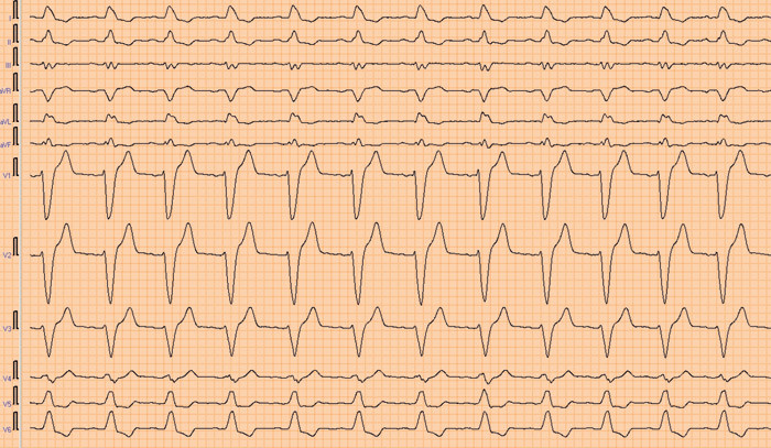 Figur 2  EKG umiddelbart etter dialyse, fortsatt betydelig bredde&oslash;kt QRS-kompleks, men smalere enn f&oslash;r dialyse og med&hellip;