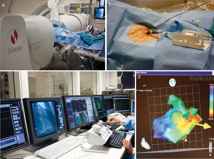 Figur 1  a) To store magneter (Stereotaxis) danner et felt gjennom pasientens brystkasse. R&oslash;ntgengjennomlysning (C-bue) er&hellip;