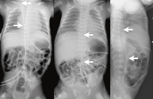 Figur 2  a) To navlevenekatetre, det ene i vena jugularis (&oslash;vre pil), det nederste i h&oslash;yre atrium (nedre pil). Frontbilde (b&hellip;