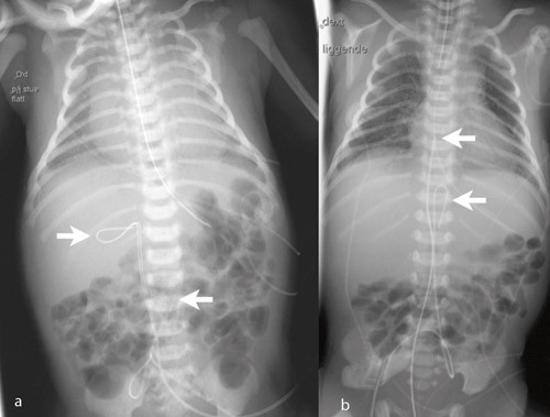 Figur 3  a) Navlevenekateter oppkr&oslash;llet i vena porta (&oslash;verste pil; nederste pil markerer navlearteriekateter i lav posisjon,&hellip;