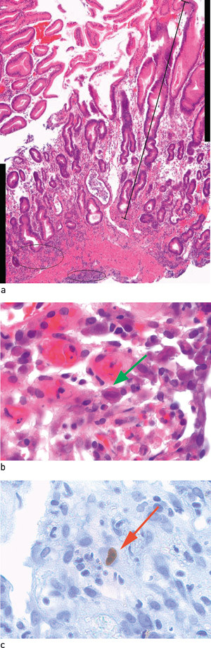 Figur 2  a) Ventrikkelslimhinne av corpustype (H&E-farging). Bemerk moderat foveol&aelig;r hyperplasi (strek) og diffus&hellip;