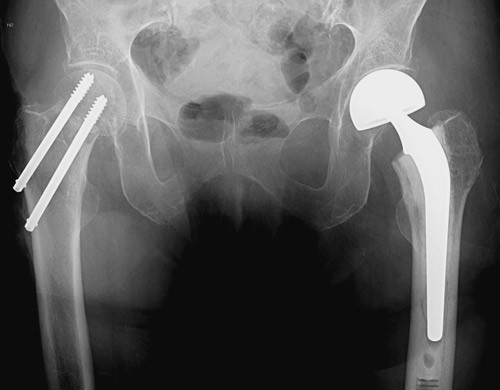 Figur 1  Pasient med bilaterale l&aring;rhalsbrudd. P&aring; venstre side har hun en bipolar sementert Charnley/Hastings hemiprotese. P&aring;&hellip;